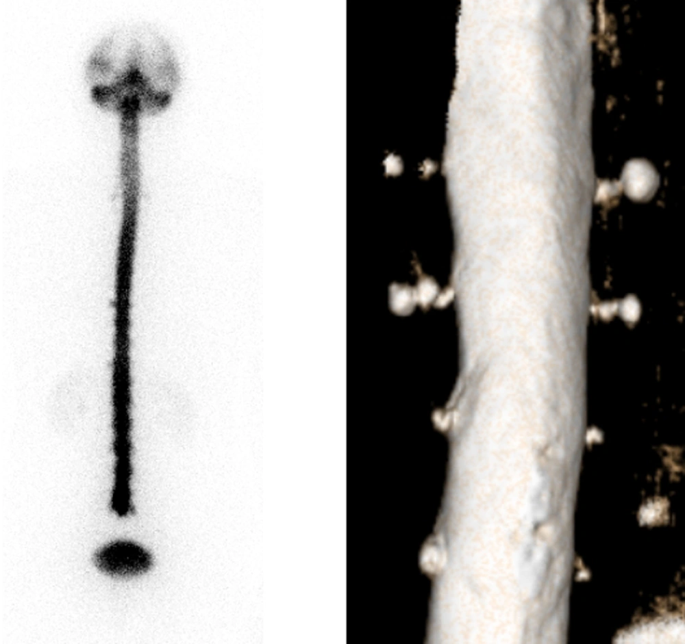 Anterior projection of a radionuclide cisternography showing multiple small images of increased radioactivity on both sides of the spinal canal (left). On the right, there is the corresponding volumetric magnetic resonance reconstruction showing multiple bilateral nerve root cysts. Anterior projection of a radionuclide cisternography showing multiple small images of increased radioactivity on both sides of the spinal canal (left). On the right, there is the corresponding volumetric magnetic resonance reconstruction showing multiple bilateral nerve root cysts.