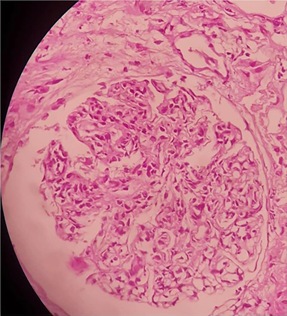 Mesangial hypercellularity and endocapillary proliferation Mesangial hypercellularity and endocapillary proliferation