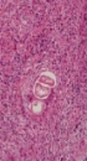 An Odd Presentation of Larval Infection: A Cardiac Mass due to Infection with Ascaridida
