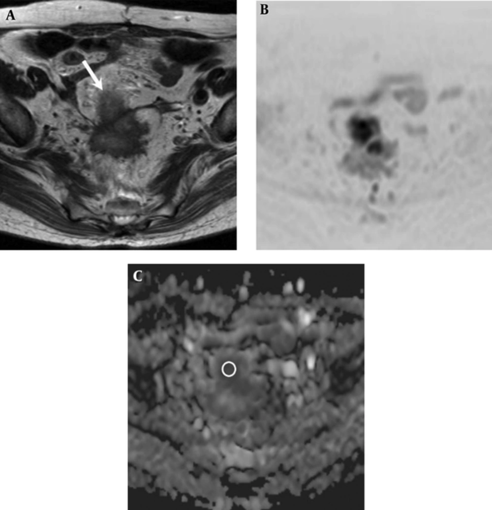 A 74-year-old woman with rectal adenocarcinoma who was diagnosed with lung metastasis 6 months after surgery. A, Axial T2-weighted image shows an ill-defined mass located in the rectosigmoid portion (white arrow). B, Diffusion-weighted image (reversed black-and-white image) and C, Apparent diffusion coefficient (ADC) map show a low ADC value (0.721 × 10<sup>-3</sup> mm<sup>2</sup>/sec) in the mass (circle in part C). A 74-year-old woman with rectal adenocarcinoma who was diagnosed with lung metastasis 6 months after surgery. A, Axial T2-weighted image shows an ill-defined mass located in the rectosigmoid portion (white arrow). B, Diffusion-weighted image (reversed black-and-white image) and C, Apparent diffusion coefficient (ADC) map show a low ADC value (0.721 × 10<sup>-3</sup> mm<sup>2</sup>/sec) in the mass (circle in part C).