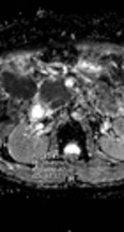 Calculating eGFR Using Apparent Diffusion Coefficient (ADC) Values Obtained Through MR Imaging