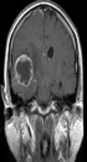 Hippocampal Sparing Post-Operative Radiation Therapy and Its Impact on Memory Function in Newly Diagnosed High Grade Glioma Patients