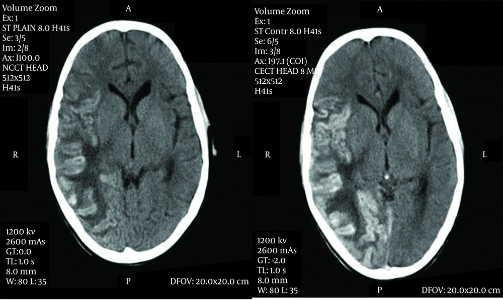 Axial Contrast-Enhanced CT Scan Images of The Brain Demonstrating Patchy Gyral Hemorrhage With Leptomeningeal Enhancement Involving the Right Temporo-Parieto-Occipital Region With Extensive Edema and Midline Shift Axial Contrast-Enhanced CT Scan Images of The Brain Demonstrating Patchy Gyral Hemorrhage With Leptomeningeal Enhancement Involving the Right Temporo-Parieto-Occipital Region With Extensive Edema and Midline Shift