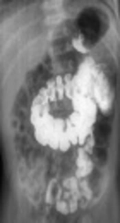 Diagnostic Value of Ultrasound and Gastrointestinal Series Findings in Detection of Pediatric Intestinal Malrotation