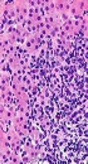 IFN-γ siRNA Effectively Knocked Down IFN-γ Gene Expression and Reduced Cytokine Secretion in Peripheral Blood Mononuclear Cells of Patients with Autoimmune Hepatitis