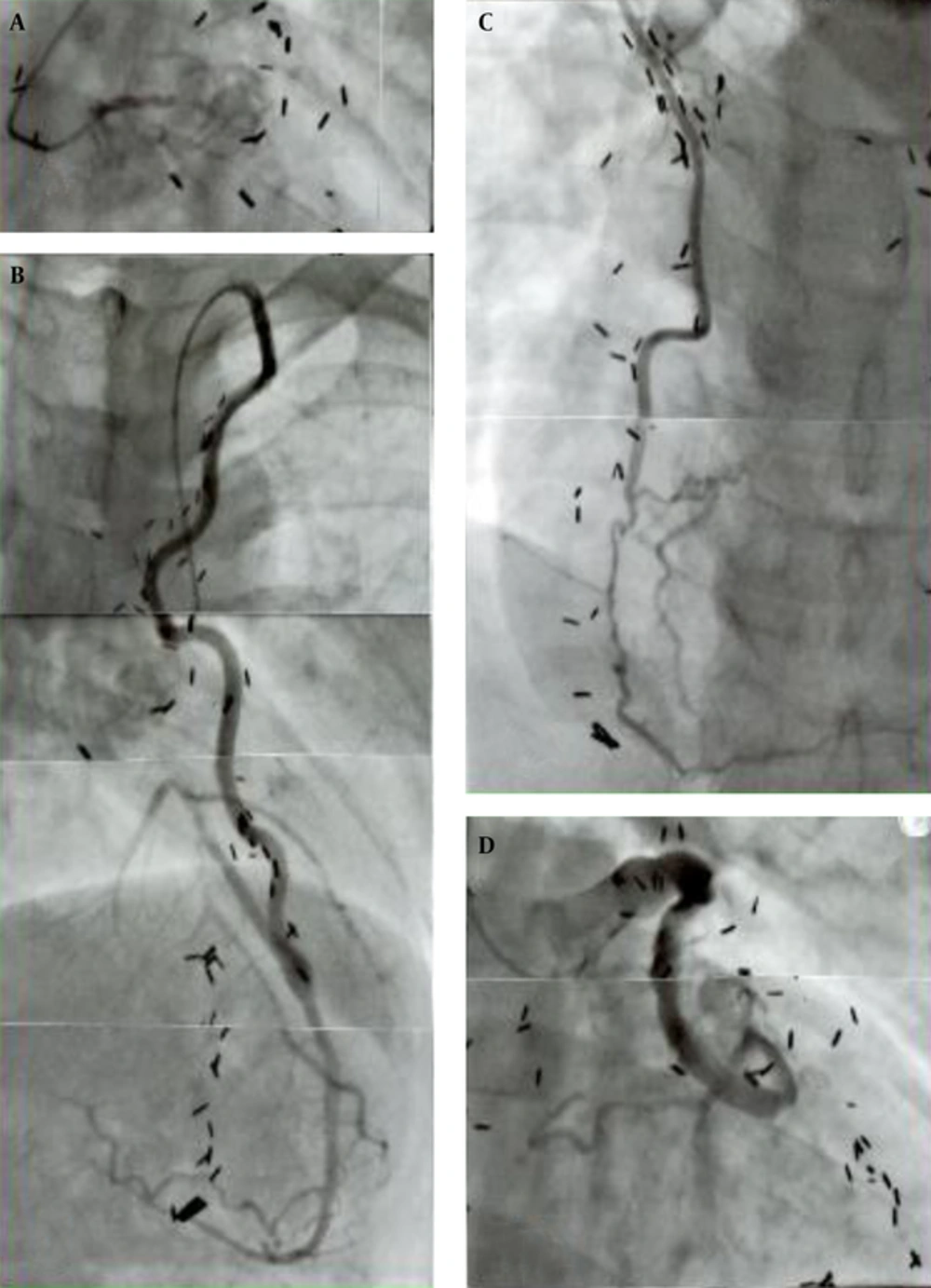Representative Graft-Coronary Angiograms in the Late Postoperative Period (> 20 Years) The boy received a triple bypass grafting at age 12 years for coronary lesions due to KD, his bilateral coronary ostia or very proximal main trunks had been totally obstructed (A); he sustained an acute myocardial infarct due to SVG-LCX artery thrombosis that occurred 24 years after the operation (D); fortunately, bilateral ITAs (LITA-LAD, RITA-RCA) were well patent (B, C) and the patient survived without complication; thrombolysis of the SVG was successfully carried out. Note the difference in configuration and wall characteristics of the ITA (B, C) and SVG (D) 24 years after the operation; presence of old SVG itself can be a cause of acute myocardial infarction; A, total obstruction of the left main trunk; B, left internal thoracic artery (LITA) -left anterior descending artery (LAD); C, right internal thoracic artery (RITA) -right coronary artery (RCA); D, saphenous vein graft (SVG) -left circumflex artery (LCX).