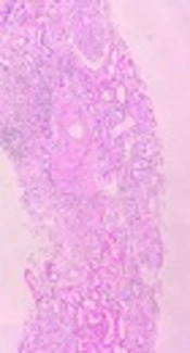 Oxalate Nephropathy Causing Irreversible Renal Failure After Roux-en-Y Gastric Bypass Surgery