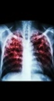 Comparing Tuberculosis Incidence in a Prison with the Society, Tehran, Iran