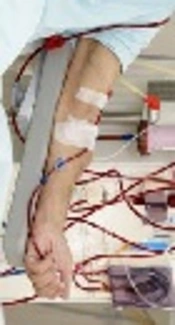 https://www.clinicaladvisor.com/psoriasis-information-center/biologic-therapy-may-be-safe-for-hemodialysis-patients-with-psoriasis/article/421547/