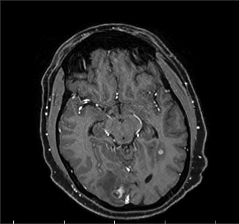 Brain MRI (navigation protocol; with and without GD): MRI shows multifocal vasogenic edema of the bilateral, parietal, right occipital, right temporal, left frontal lobes, and subcortical white matter lesions in both cerebellar hemispheres, indicating a multifocal abscess. No evidence of thrombosis, aneurysm, or AVM was detected in brain MRV and MRA scans. Brain MRI (navigation protocol; with and without GD): MRI shows multifocal vasogenic edema of the bilateral, parietal, right occipital, right temporal, left frontal lobes, and subcortical white matter lesions in both cerebellar hemispheres, indicating a multifocal abscess. No evidence of thrombosis, aneurysm, or AVM was detected in brain MRV and MRA scans.
