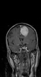 Apparent Diffusion Coefficient (ADC) and First-Order Histogram Statistics in Differentiating Malignant Versus Benign Meningioma in Adults