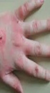 Clinical Aspects of Scrub Typhus Initially Misdiagnosed as Kawasaki Disease