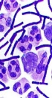 Lipoglycopeptide Antibiotics: Reliable Fighters Against Gram-Positive Pathogens