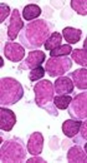 Simultaneous Occurrence of Multifocal Osteomyelitis in a Child with Acute Lymphoblastic Leukemia: A Rare Manifestation During the Maintenance Phase of Treatment