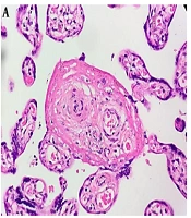 Archives of Pediatric Infectious Diseases