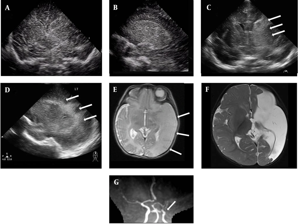 ultrasound scan on day 3 (A, B) and day 5 (C, D) of life with coronal and left parasagittal views showed increased echogenicity over the thalamus and basal ganglia. The echogenic area was more apparent on day 5 than day 3 of life (arrow). On day 5 of life, T2WI showed left MCA territory infarction with a “missing cortex sign” (E) (arrow), and MRA showed flow reduction in the left MCA (G) (arrow). Multicystic encephalomalacia was demonstrated on T2WI when the patient was 8 months old (F). ultrasound scan on day 3 (A, B) and day 5 (C, D) of life with coronal and left parasagittal views showed increased echogenicity over the thalamus and basal ganglia. The echogenic area was more apparent on day 5 than day 3 of life (arrow). On day 5 of life, T2WI showed left MCA territory infarction with a “missing cortex sign” (E) (arrow), and MRA showed flow reduction in the left MCA (G) (arrow). Multicystic encephalomalacia was demonstrated on T2WI when the patient was 8 months old (F).