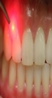 Hard Tissue Laser Applications in Pediatric Dentistry