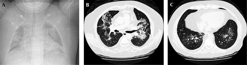 Chest X-ray and CT Section Images Results A. CXR of diffuse bilateral perihilar opacity with extension to periphery of upper and lower lobes; B, C. CT section images, bilateral perihilar alveolar ground glass opacity with extension to periphery of the upper and lower lobes.