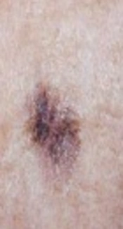 Melanoma and Associated MicroRNAs