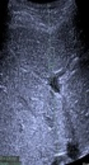 The Role of Linear and Convex Probes to Determine the Normal Range of Splenic and Liver Stiffness in Healthy Children Assessed by Point Shear Wave Elastography