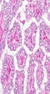 The Association of BRAF V600E Mutation With Tissue Inhibitor of Metalloproteinase-3 Expression and Clinicopathological Features in Papillary Thyroid Cancer