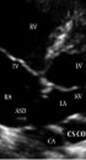 Mixed Type Total Anomalous Pulmonary Venous Connection in a Newborn