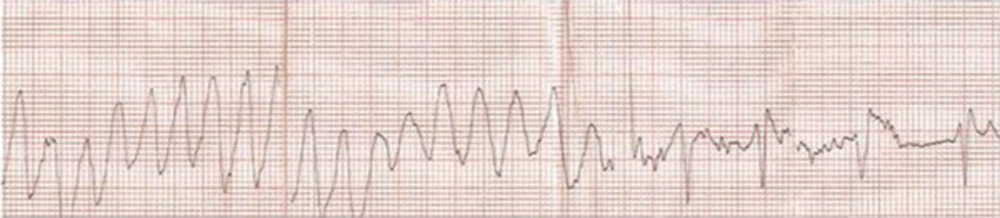 Torsade de Pointes (TdP) TdP stopped after overdrive pacing.