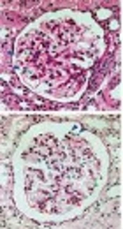Osteocalcin Level in Children with Steroid Dependent/Frequently Relapsing and Steroid Resistant Nephrotic Syndrome