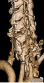 Variations in the Origin and Course of the Extracranial Vertebral Artery on Multidetector Computed Tomography Angiography