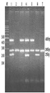 The Relationship Between Polymorphisms of Glutathione S-Transferase (GSTM1, GSTT1) Gene and Type 2 Diabetes Mellitus in Western Iran