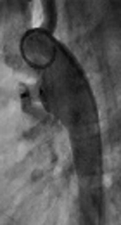 Is There Any Correlation Between Two and Three Dimensional Echocardiography in Ductal Dimensions with Angiography?