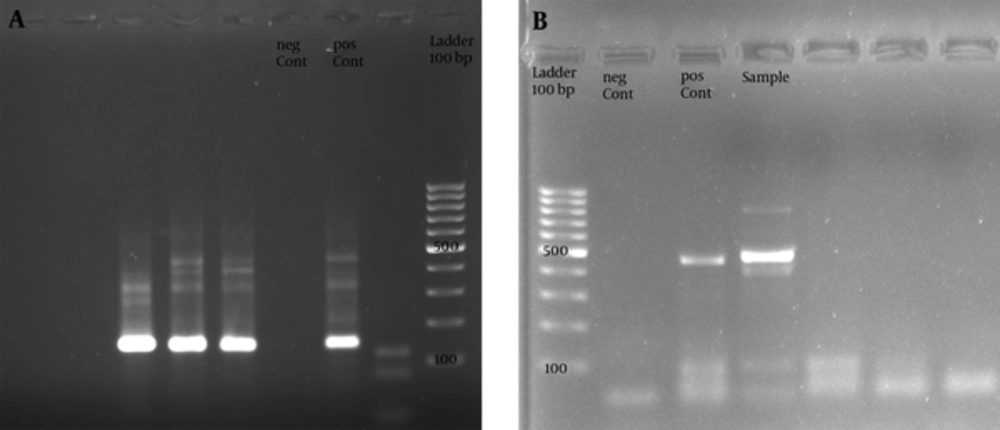 The Gel Image from PCR Product of Nested PCR Using GP Sets Giving a 140 bp Product (A), and Outer Reaction with MY Primers Produced a 450bp Fragment of L1 Gene (B) The Gel Image from PCR Product of Nested PCR Using GP Sets Giving a 140 bp Product (A), and Outer Reaction with MY Primers Produced a 450bp Fragment of L1 Gene (B)