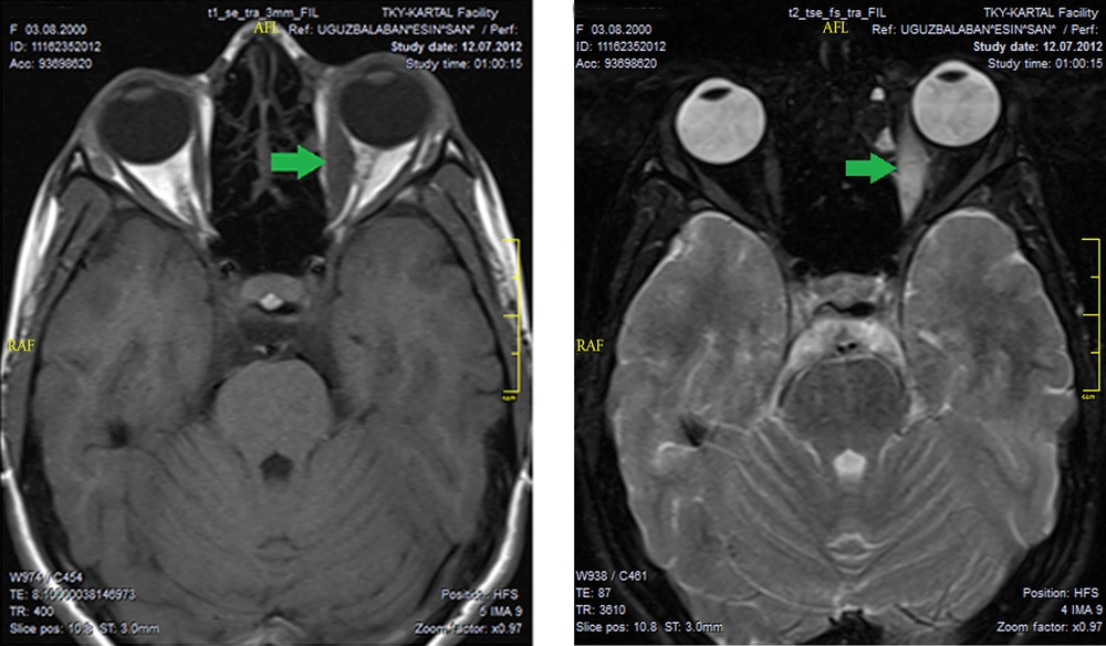 A, T1; B, T2 A, T1; B, T2