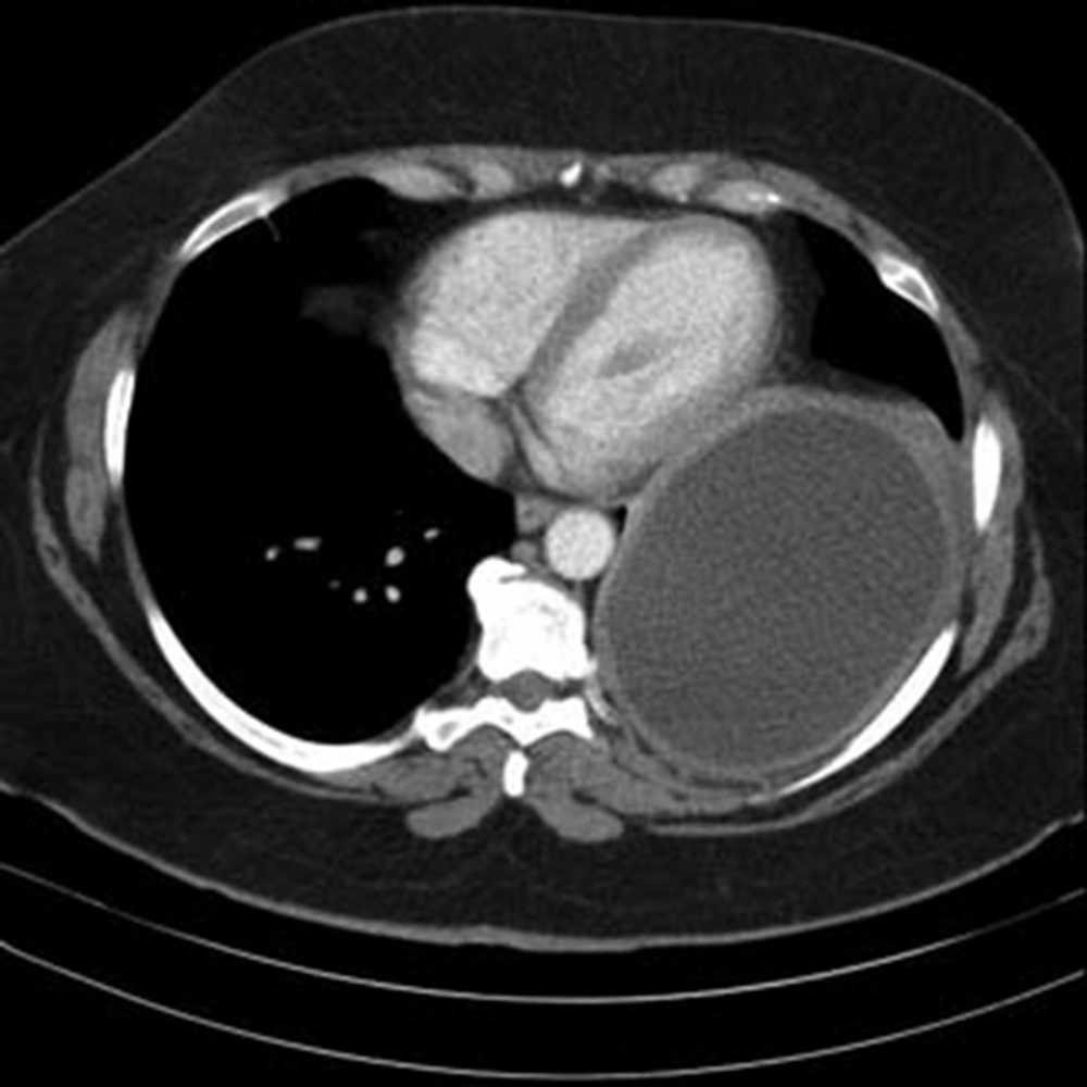 Chest CT-Scan Chest CT-Scan