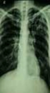 Pulmonary Tuberculosis