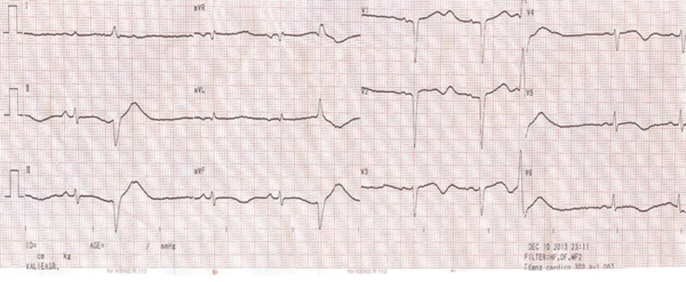 The Electrocardiography (ECG) Data Upon CCU Admission The Electrocardiography (ECG) Data Upon CCU Admission