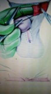 Duckett versus Modified Bracka Technique for Proximal Hypospadias Repair A 10-Year Experience