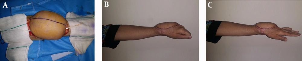 A, Tendon Reconstruction With Palmaris Longus and Plantaris Tendon Graft; B, Reconstruction After Debulking (Finger Flex); C, Reconstruction After Debulking (Finger Ext) A, Tendon Reconstruction With Palmaris Longus and Plantaris Tendon Graft; B, Reconstruction After Debulking (Finger Flex); C, Reconstruction After Debulking (Finger Ext)