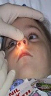 Management of Foreign Bodies in the Mouth, Nose and Ears in Children in the Emergency Room