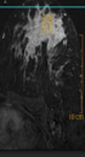 Comparison of Different Dynamic Contrast Enhanced-Magnetic Resonance Imaging Descriptors and Clinical Findings Among Breast Cancer Subtypes Determined Based on Molecular Assessment