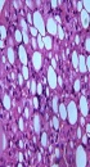 Model for Non-Invasive Diagnosis of NAFLD Incorporating Caspase 3-Cleaved Cytokeratin-18: A Clinical, Serological, and Immunohistochemical Analysis