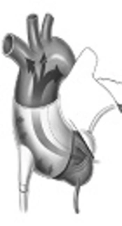 Cardiac Compression Devices: Alternative Technology and Innovative Concept