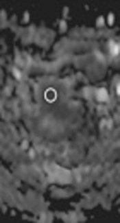Prognostic Value of Diffusion MR Imaging and Clinical-Pathologic Factors in Patients with Rectal Cancer