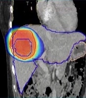 Reports of Radiotherapy and Oncology