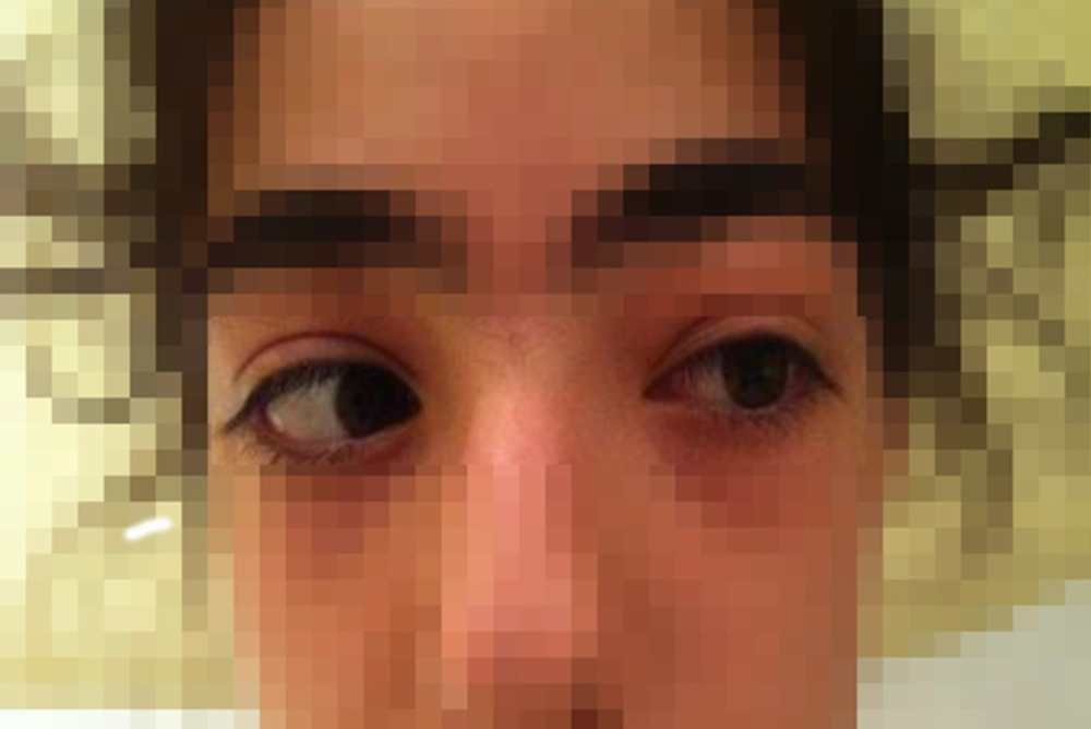 Limitation of Left Ocular Eye Movement Limitation of Left Ocular Eye Movement