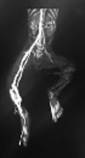 Treatment of Neonatal Arterial Thromboembolism: A Case Report