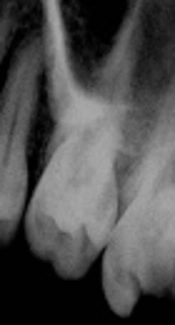 Root Canal Treatment of a Maxillary Second Molar with Two Palatal Roots: A Case Report