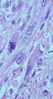 Primary Leiomyosarcoma of Bone: A Case Report