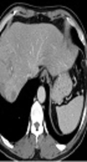 Synchronous Occurrence of Classic and Scirrhous Hepatocellular Carcinomas: A Case Report
