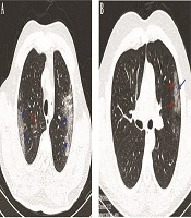 Archives of Clinical Infectious Diseases